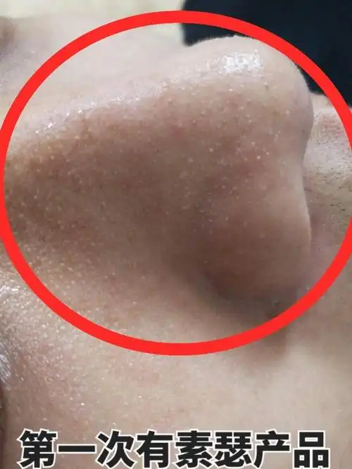 去黑头粉刺妙招(去黑头粉刺妙招视频)_大全-幸福起航