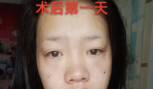术后第一天至第12天自体脂肪填充泪沟术后恢复效果分享