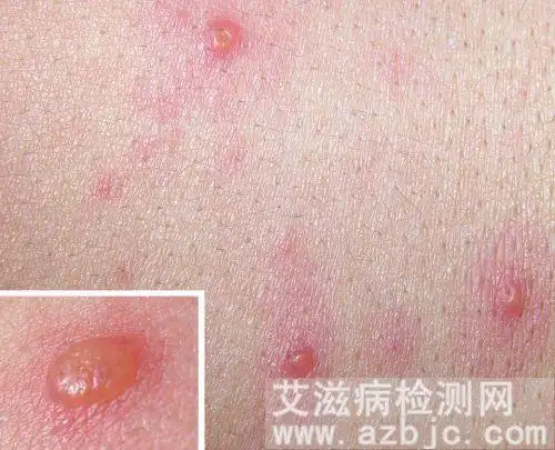 女人艾滋病的三大症状,女性hpv初期小红点照片