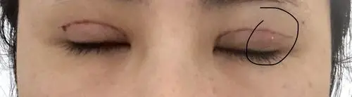 全切双眼皮手术后线结反应什么时候能消失,会消失无痕吗?