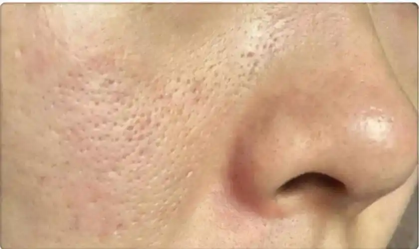 原创毛孔粗大怎么办掌握这些技巧有效改善皮肤毛孔粗大的问题