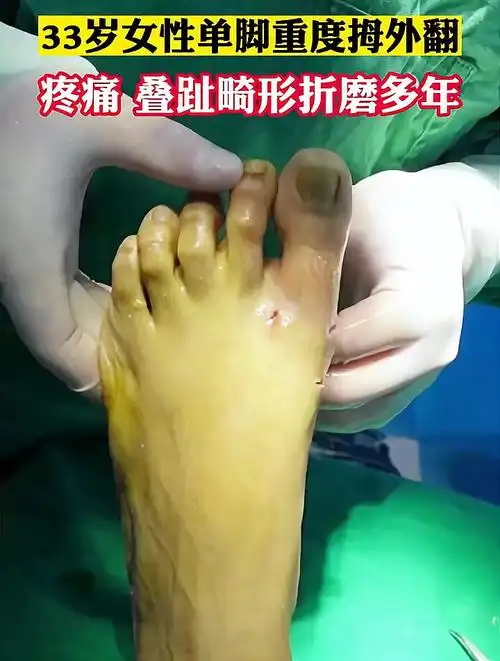 33岁女性单脚重度拇外翻,疼痛,叠趾畸形折磨多年
