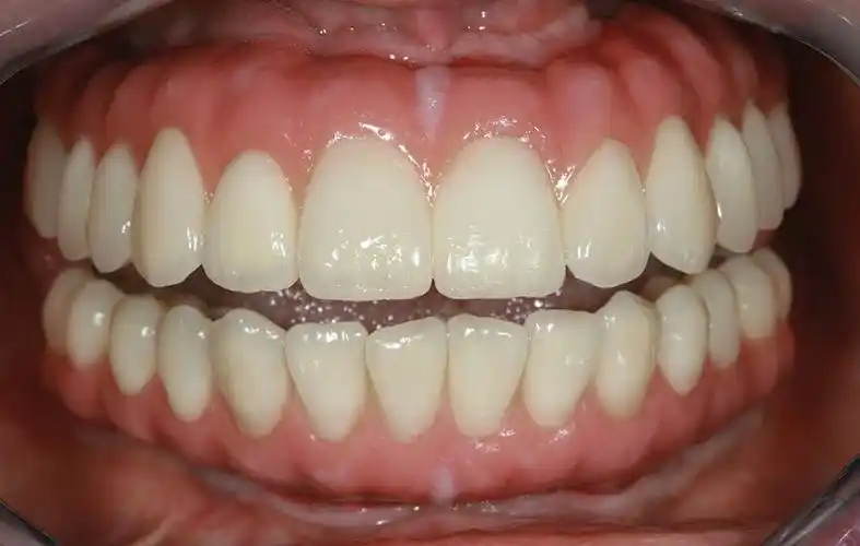 全口种植病例解读_牙齿种植_介绍_治疗方式 - 好大夫在线