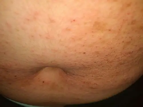 肚子上张了很多这种红点点 很痒!