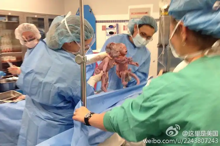 美国俄亥俄州的萨拉·西斯尔思韦特生下一对单羊膜双胞胎