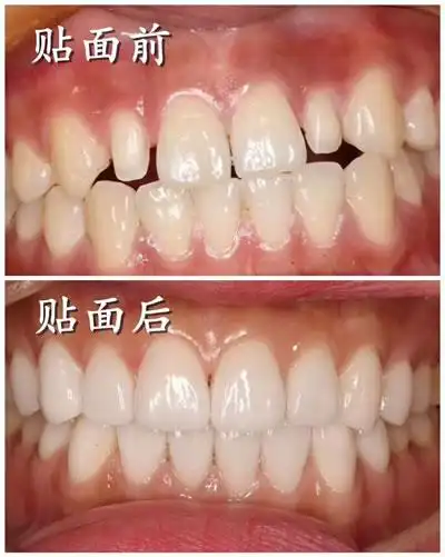 牙齿美白用冷光还是贴面?哪种效果更好价格更划算?-医秀网