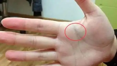 胃癌早期不疼不痒,只要手上出现这东西,晚了医生也救不了你