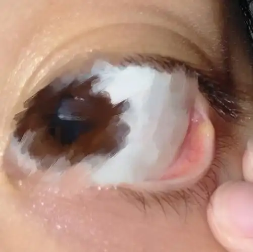 左眼眼角有一个黄色包包大概一两个月前很小没注意现在变大了