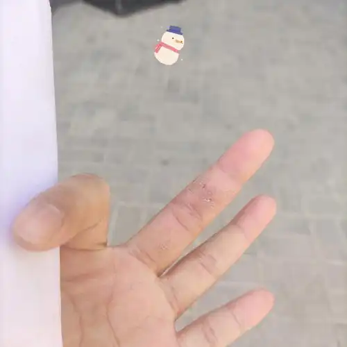 这就是角质化手癣