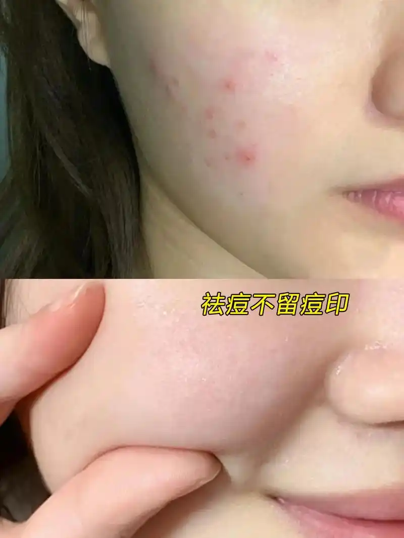 一直用的祛痘方法