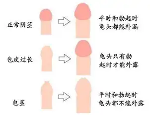 正常的阴茎与包皮包茎的区别