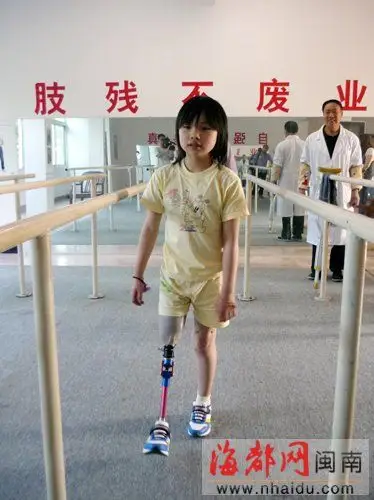 女孩遇车祸截肢遭弃续小思浓安上临时假肢训练