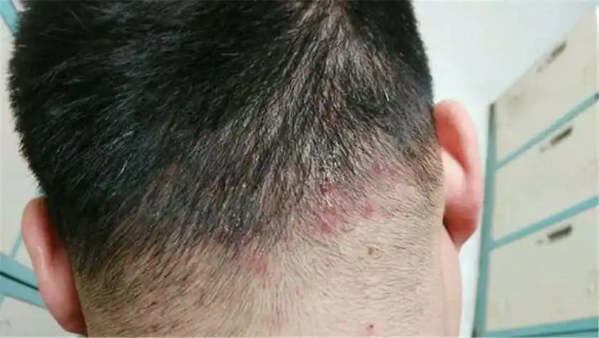 毛囊炎是因为毛囊出现了细菌或者是真菌感染导致的,会出现红色的疙瘩