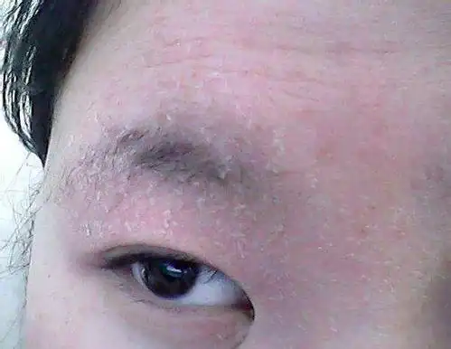 脸部皮肤干燥起皮发红相关文章