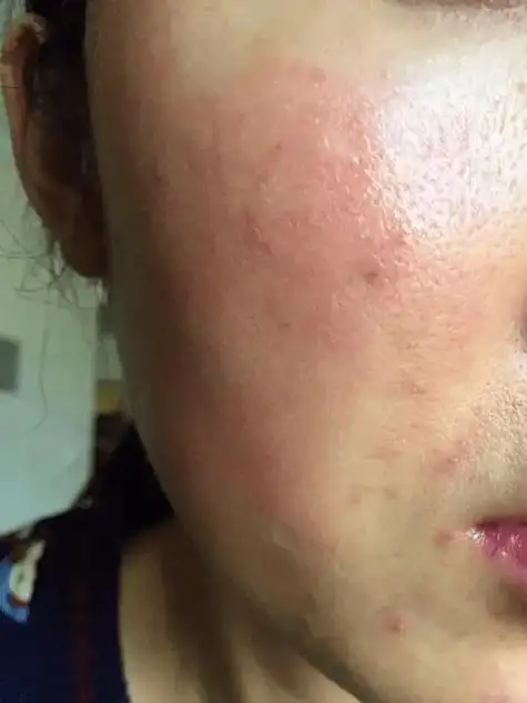 皮肤_肌肤_微血管