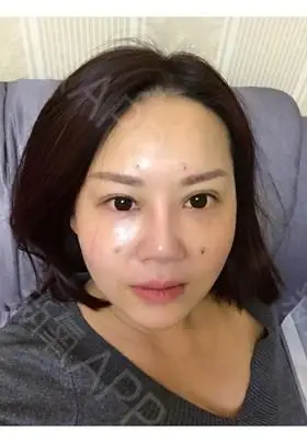 武汉自体脂肪丰泪沟好不好_效果图_氧气e7qea38自体脂肪丰泪沟术后第