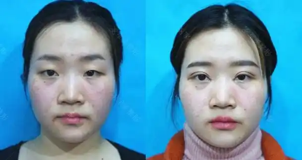 双眼皮做哪种好?割双眼皮对比图?