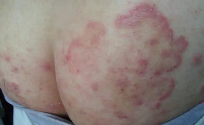 凡由致病性真菌侵犯腹股沟内侧所致环状或半环状皮损者统称为股癣