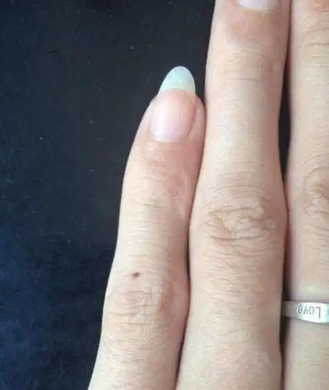 女人脚右小指长痣命好不好-星座大全-小星座网