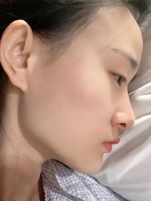 削下颌角三个月花费五w,我妈都说值了!