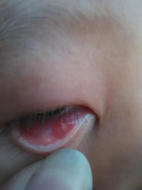 宝宝一周九个月了右眼下面长了个水泡是什么?急急