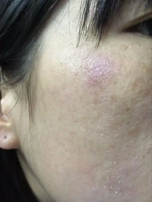 脸上红红的,又很痒,摸起脸部来很粗糙,干燥并且带有脱皮现象.