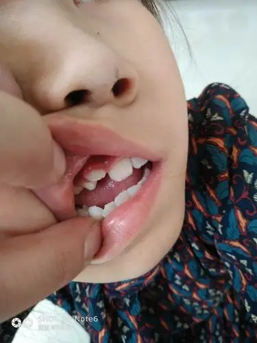 女儿的牙怎么了长外面了怎么办?