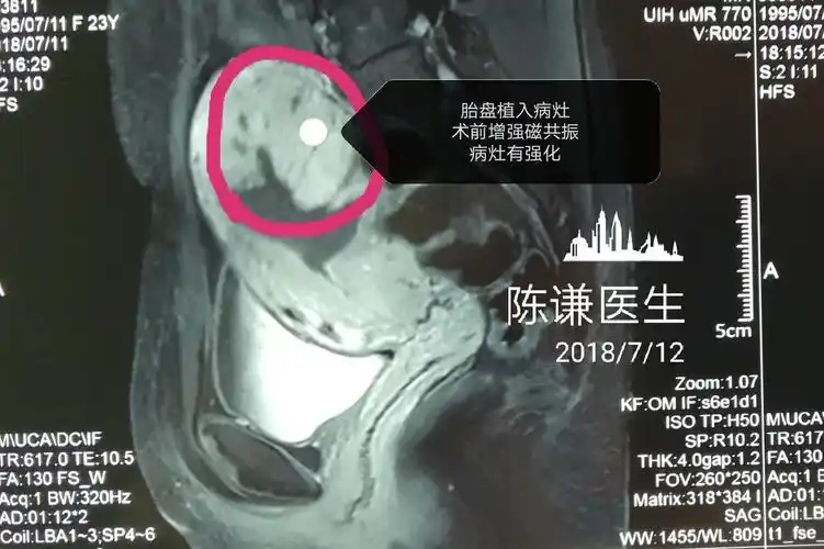 胎盘植入海扶手术保留子宫病历分享_治疗