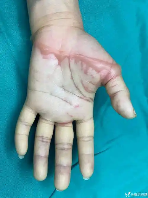 这种烫伤你见过吗