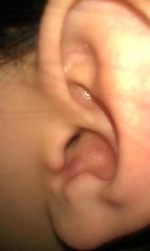 我左耳朵里面长了个包,用手摸有点痛,不知怎么回事,严重吗?