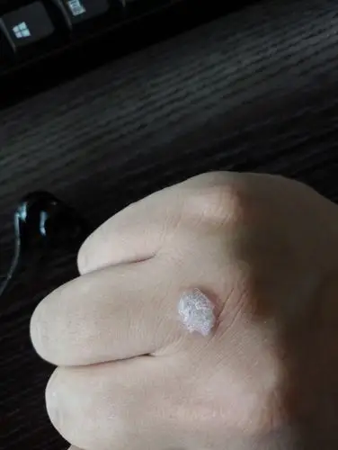 手背之前长了扁平疣用液氮治疗后被冻伤了现在伤口上长了一层