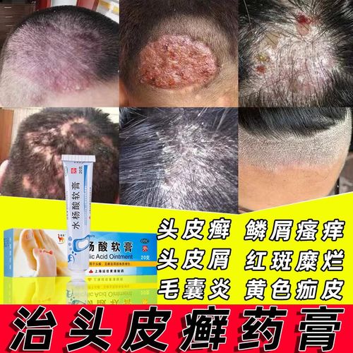 头皮脱发 头皮癣怎么治 水杨酸软膏 3盒【红疙瘩起皮块状脱屑瘙痒反