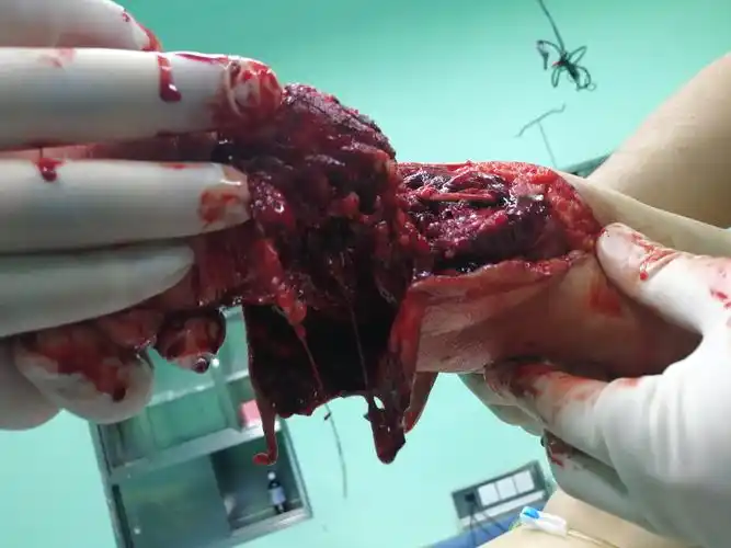 踝关节不全离断伤