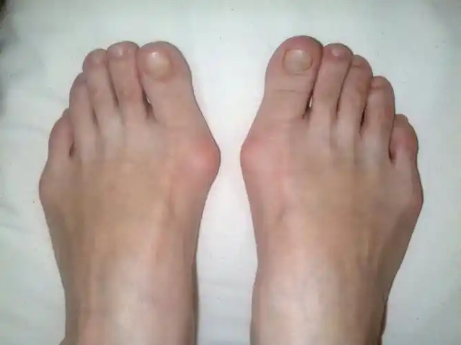 2012年第一例拇外翻(更新图片) - 好大夫在线