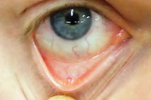 再看体征:面色苍白,对于如何判断是否苍白可以扒开自己得下眼睑看看