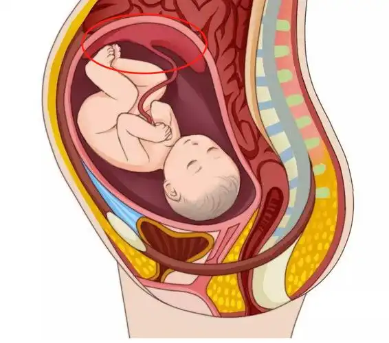 好不容易才怀上孕却又遇到胎盘植入