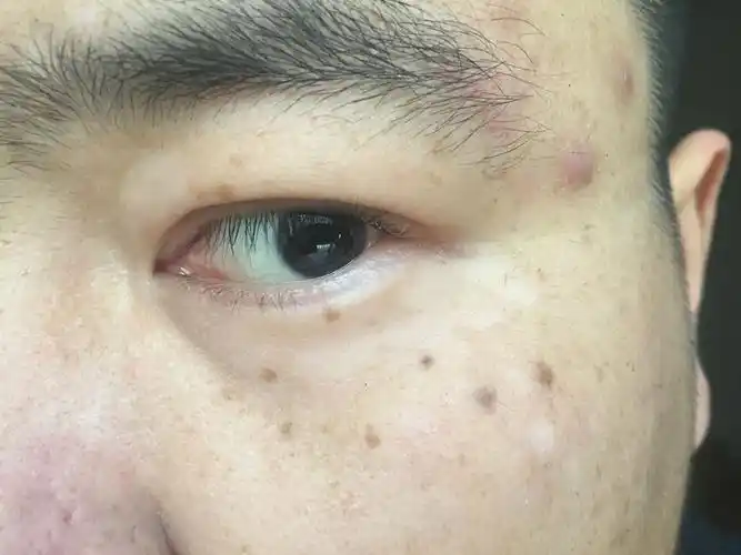 眼睛下面白色的部分是白癜风么