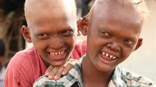 印度兄弟俩满嘴尖牙一头黄毛被称鬼男孩,没人和他们玩遭同学排斥