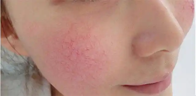 激光去红血丝会不会留疤?