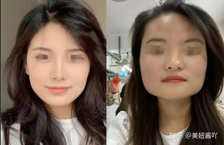 因为方脸脸宽下颌骨肥大而自卑怎么办该不该削骨