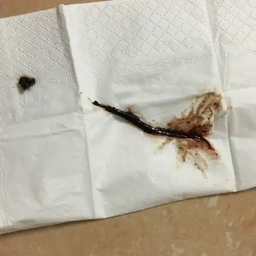 今天阴道突然出了分泌物深棕色带点血色!请问我怎么了!是不是得了什