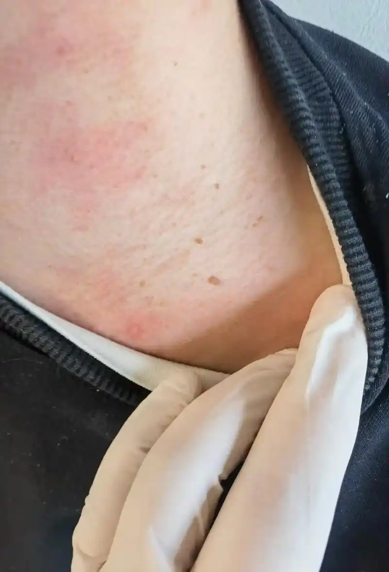 新鲜出炉 扁平疣前后效果对比图!前三张是治疗前,后6张是治 - 抖音