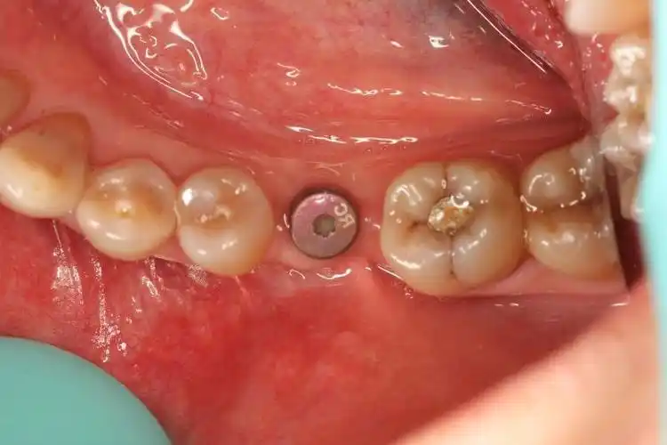 种牙日记(三):拆线&复查