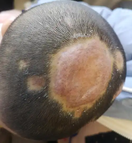 对于头癣的治疗,早期以灰黄霉素为主,近年来被安全性等更好的其他抗