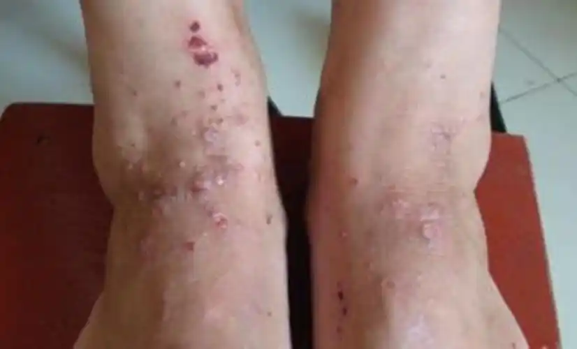 皮肤病的种类图片大全红斑图片