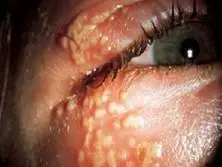 病毒性眼睑皮炎多发生在全身,根据临床表现分为水泡型,皮疹型和新生物