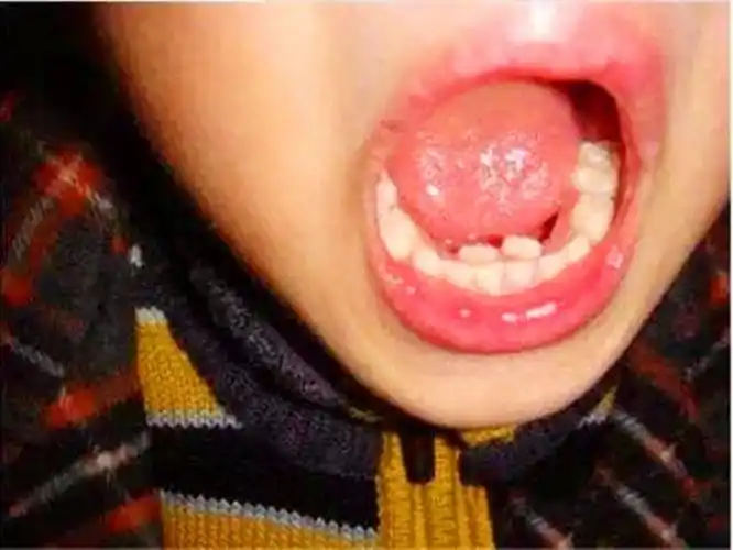 7岁孩子长出"双排牙",原因竟是长期吃这个惹的祸,家长要当心