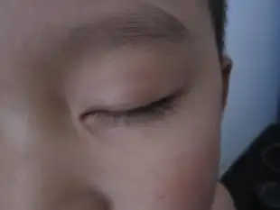 孩子眼角白癜风不断扩散家长心急如焚结果白斑