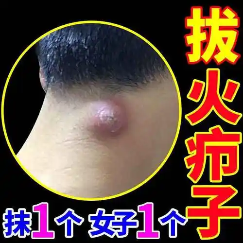 疖子是一种常见的化脓性疾病,通常发生在毛囊或皮脂腺的周围组织,常见