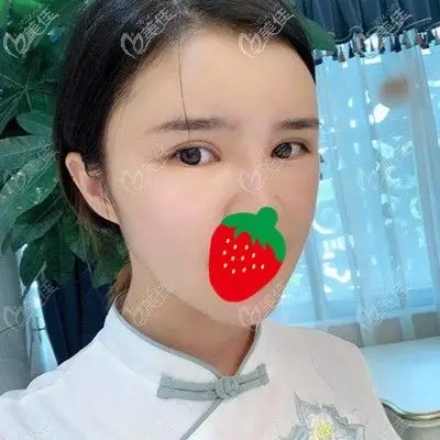 面部填充一个月报到,现在恢复的越来越好了,看着